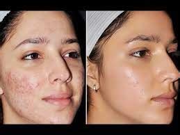 Best Acne Treatment in Bangalore, Acne Treatment Cost - ISAAC Luxe