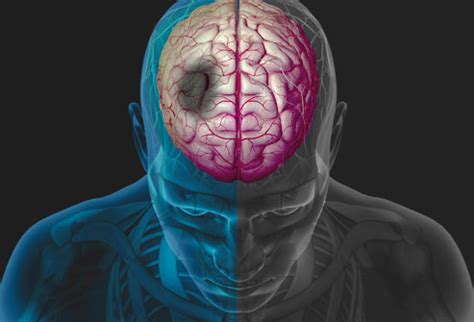 However, research has also shown that this type of stroke has twice the mortality rate of more common cerebral stroke. Signs & Symptoms of Stroke - Knoxville CPR by CPR Choice ...
