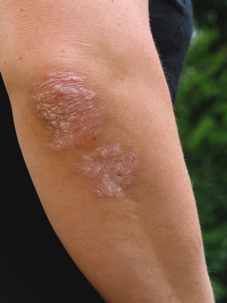 Plaque Psoriasis Photos What Is Psoriasis Symptoms And Causes