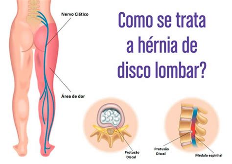 Dor Lombar Dr Honorato