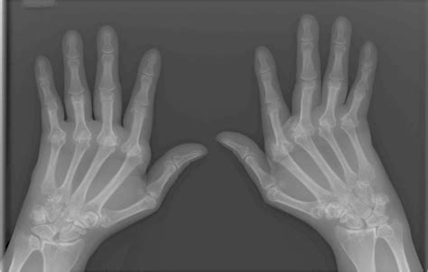 Nih Research Leads To New Rheumatoid Arthritis Drug Nih Directors Blog