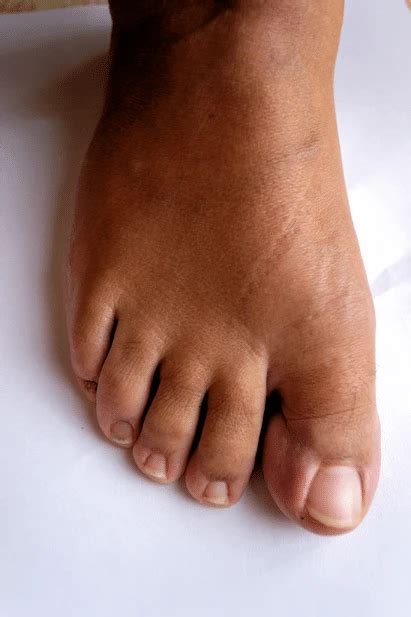 Hallux Limitusrigidus Treatment Victoria Foot And Ankle Center