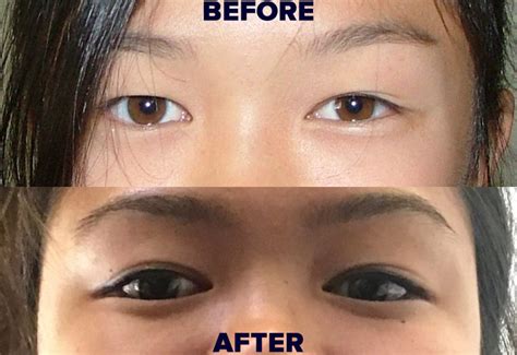 How To Have Double Eyelids Permanently Without Surgery Oultet Website