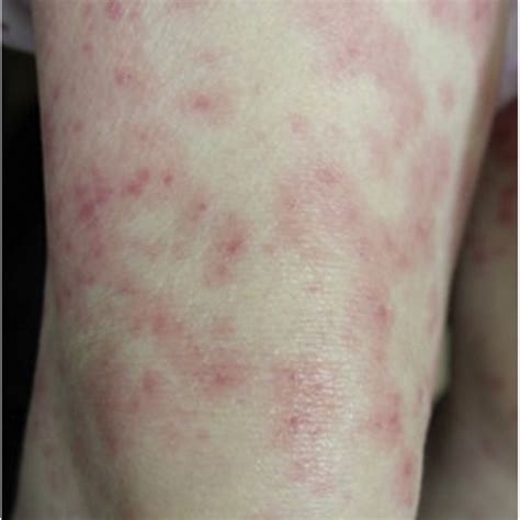 Erythema Multiforme Like Eruption The Patient Presented With A Skin