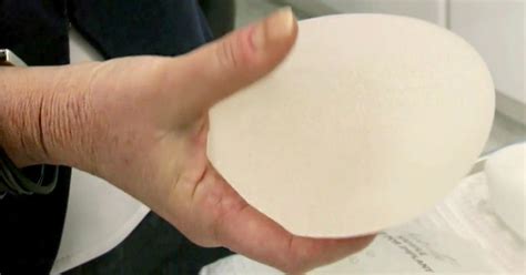 Recall Alert Textured Breast Implant Tied To Rare Cancer Taken Off Us