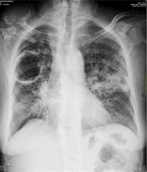 On radiograph tubercular lesions of lung parenxyma, stroma comes to light as shadows (densities, consolidations). TB Cavity | Radiology imaging, Radiology, Radiology ...