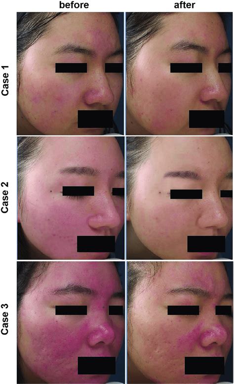 Ipl Before And After Rosacea