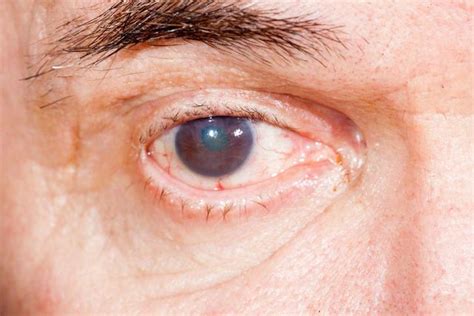 How Does Diabetes Affect The Eyes Symptoms Diabeteswalls