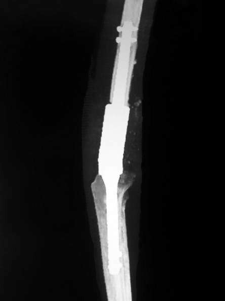 Lateral Radiograph Of The Distal Third Of The Left Femur And Knee 24
