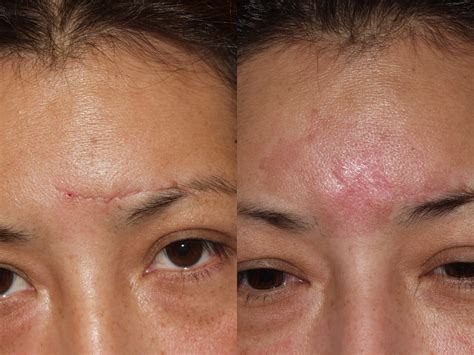 Before And After Pictures Scar Revision Chicago Il Dr Sidle