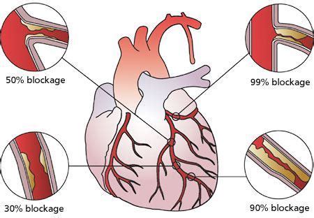 Coronary Artery Disease Causes Symptoms Treatments And Other Medicines