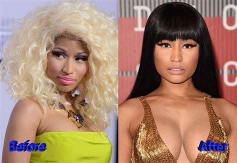 Nicki Minajs Before And After Plastic Surgery Photos Look Extremely