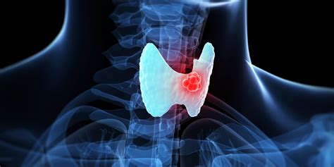 Thyroid Cancer Awareness Month 5 Important Things To Know About