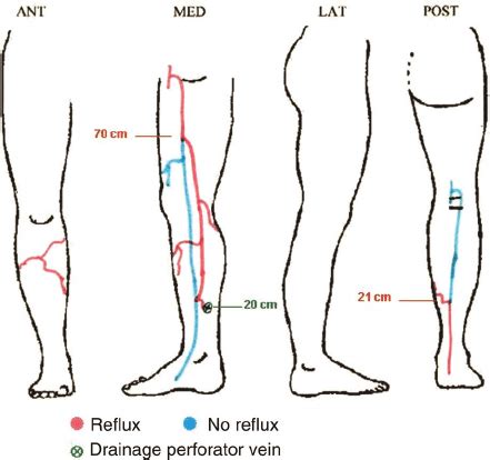 Example of the schematics of a lower extremity vein ...