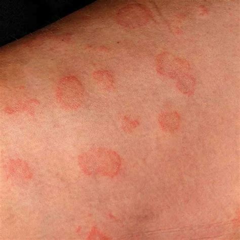 Viral Skin Infections