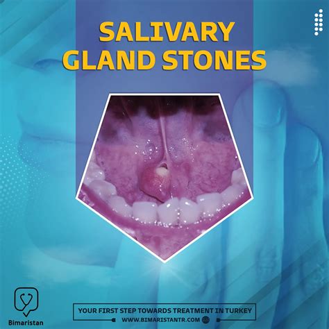 Treatment Of Salivary Gland Stones In Turkey And The Reasons For Their