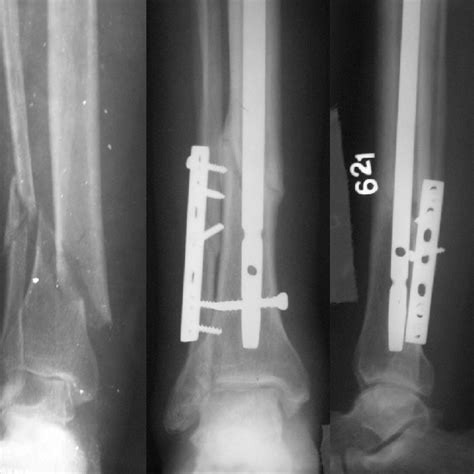 PDF Intramedullary Nailing And Plate Osteosynthesis For Fractures Of The Distal Metaphyseal