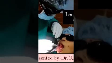 Leukoplakia New Case Complete Treatment In Only Two Setting By Laser