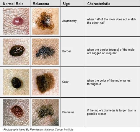 Skin Cancer Moles Types And Symptoms With Pictures
