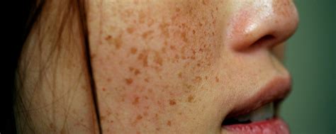 What Causes Pigmentation The Skin Studios
