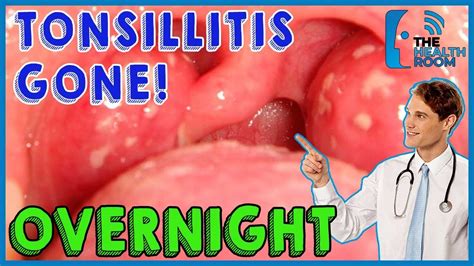 10 Effective Tonsillitis Home Remedies That Work Fast Youtube