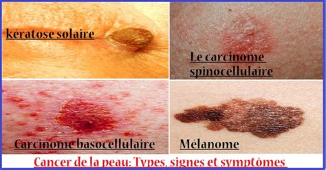 Cancer De La Peau Types Signes Et Symptômes Sport Et Santé