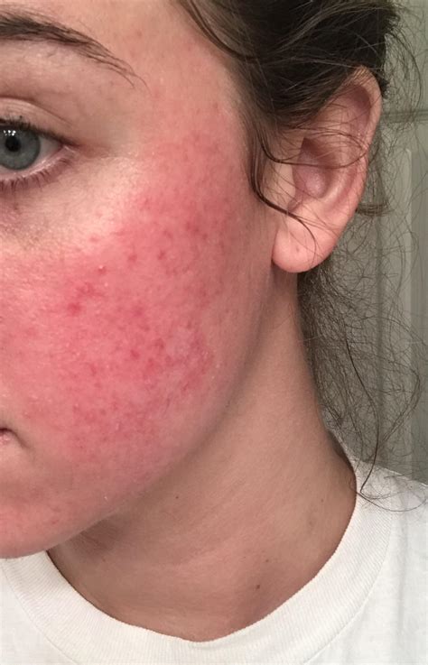 Could This Be Acne Rosacea This Has Been On My Face For 6 Months Now