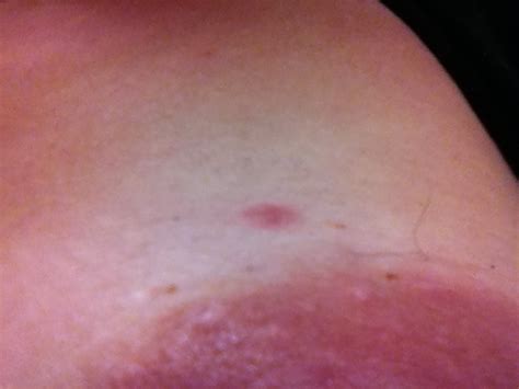 Often, you might not feel a lump, even if it is there. Breast Cancer Topic: Worried