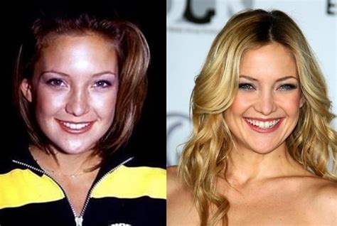 Kate Hudson Before And After Plastic Surgery Boob Nose Teeth