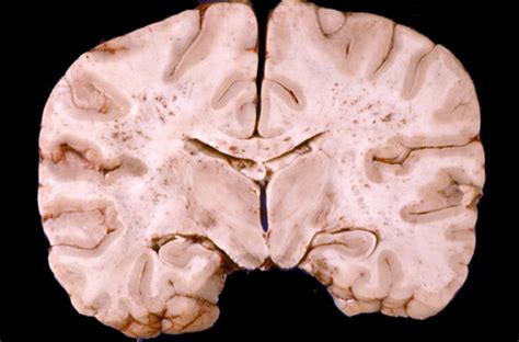 Caused by fat globules in pulmonary microcirculation. Forensic Pathology