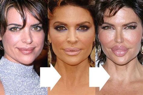 Lisa Rinna Facelift Lip Injection And Cheek Implan Lipgloss Celebrity Plastic Surgery Lip