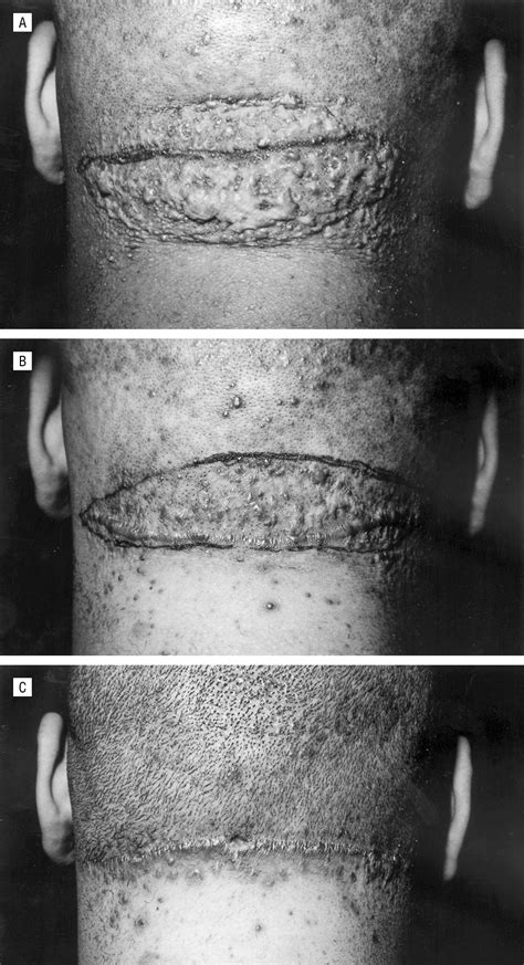 The Surgical Management Of Extensive Cases Of Acne Keloidalis Nuchae