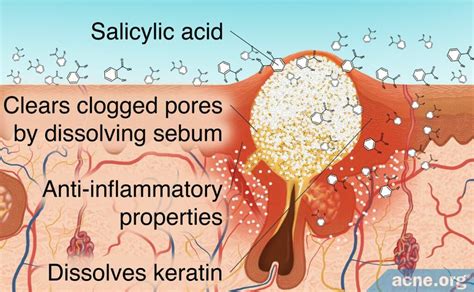 Salicylic Acid Acne Org