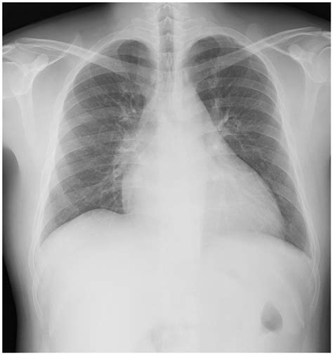 Chest X Ray Shows Cardiomegaly And No Pulmonary Edema Download