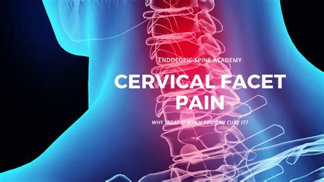Why Manage Cervical Facet Pain When You Can Cure It Endoscopic Spine