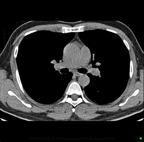 Chest Ct Scan Melbourne Radiology