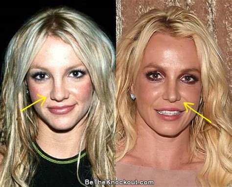 Britney Spears Plastic Surgery Comparison Photos