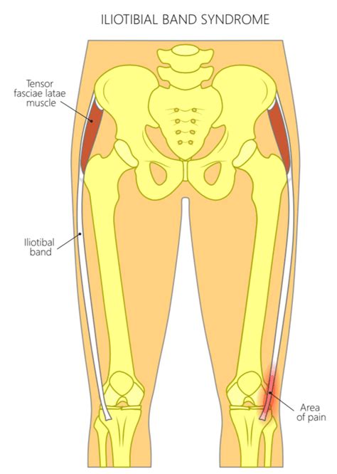 Iliotibial It Band Tendonitis Of The Knee Upswing Health Upswing