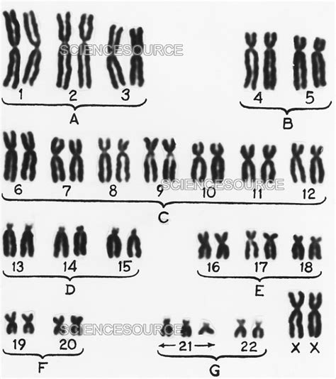 Photograph Female Karyotype Showing Downs Syndro Science Source Images