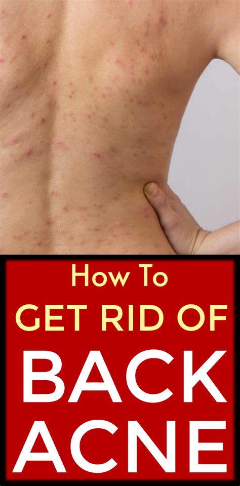 How To Get Rid Of Back Acne Easy Home Remedies Backacne Acne