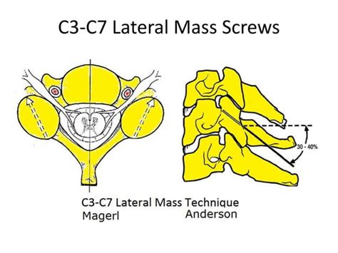 Lateral Mass Screws