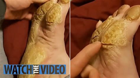 Removing Extremely Hard Foot Callus The Right Way To Remove Foot