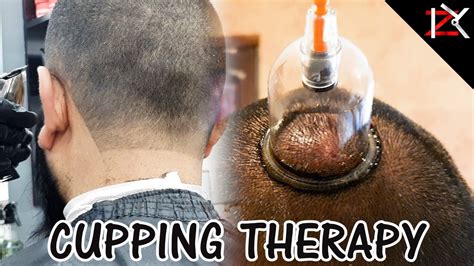 How To Cure Headaches Wet Cupping Therapy Performed Migraine