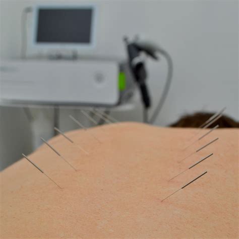 Medical Acupuncture At Tide End Clinic Teddington