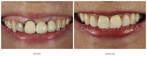 Coronas De Porcelana Clínica Dental Clinica Eva Berroeta