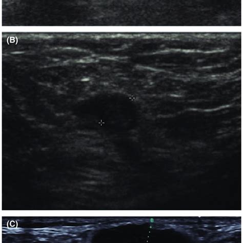 Ultrasound Images A Ultrasound Image Of A Normal Lymph Node In The