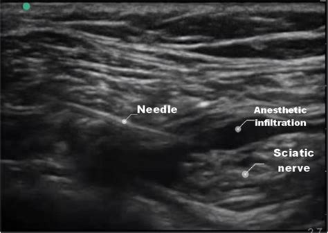 The Landmarks Of Sciatic Nerve Block And Local Anesthetic Injection