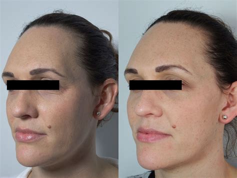 Botox Before And After Photos Palm Clinic