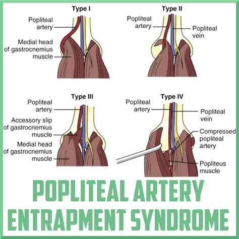 Popliteal Artery Entrapment Syndrome Sports Medicine Review