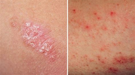 Eczema Vs Psoriasis How To Tell What Youre Dealing With Pretty
